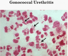 Urethritis is inflammation of the urethra with symptoms of muco-purulent or purulent discharge, dysuria and/or urethral pruritus. Mainly caused by the STIs Chlamydia (most common bacterial STI) and Gonorrhea (2nd most). Coinfection of the the two ...