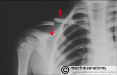 Name the fracture. Where does most commonly occur?