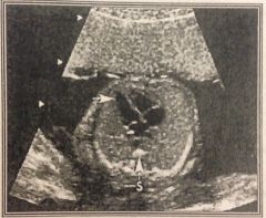 What does this ultrasound image demonstrate?