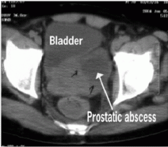 A prostatic abscess is a rare complication of acute bacterial prostatitis. Symptoms can mimic those of ABP: fever, obstructive voiding symptoms, sepsis. Management requires abscess drainage and antibiotics. 