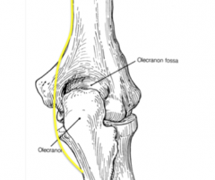 The Hueter line between the olecranon and lateral epicondyle should be straight