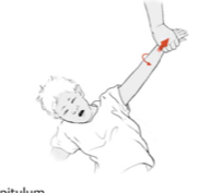 Proximal incomplete temporary dislocation at the head of the radius-Nursemaid's elbow