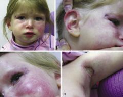 Myopathy, Heliotrope rash, Gottron's papules over knuckles, joint involvement, dilated capillary nailbed vessels