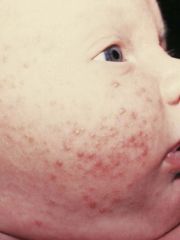 Neonatal (cephallic pustulosis) vs infantile acne

(Above is neonatal)