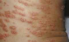 Psoriasis. Red, well-demarcated plaques covered with dry, thick, silvery scales.  Lesions of psoriasis are often induced at sites of local injury such as scratches, surgical scars, or sunburn, a response termed the Koebner phenomenon