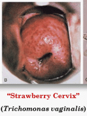 Cervicitis can either be endo- or ecto-cervicitis. Endo-cervicitis is due to STIs such as N. gonorrhoeae, C. trachomatis, M. genitalium and T. vaginalis. Ecto-cervicitis is typically non-infectious, except due to HIV. 


 


There will be mu...