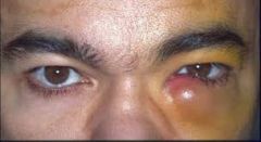 infection of lacrimal duct
Tx: oral and topical abx