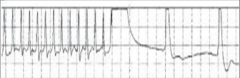 Cardioversion delivers a synchronized shock to terminate AF and SVT