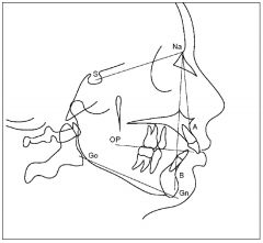 A ( maxilla protruded)