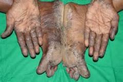 Acrokeratosis paraneoplastica associated with?
