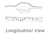 Draw where the knife would cut for a biopsy in the longitudinal view 