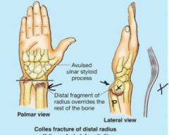 A fracture of the distal radius where the distal segment is displaced dorsally giving the dinner fork shape (ie dinner fork deformity) this is a common injury in the elderly