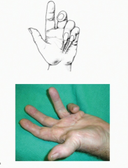 A fibrosis of the palmar fascia and the palmar aponeurosis which is painless. This pressure pulls on the longitudinal bands on the 4th and 5th fingers causing partial flexion at MCP and PIP joints. This can only be fixed by a surgical cut of the f...