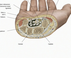 The median nerve in carpal tunnel syndrome