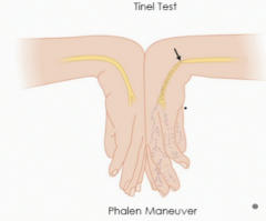 Tinel Test-firm percussion over the medial nerve just proximal to or on top of the carpal tunnel
Phalen Maneuver-placing backs of hands against each other this hyperflexion will be painful within one minute