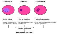 - all ncl changes are due to breakdown of DNA and chromatin by lysosomal enzymes (proteases and nucleases)
pyknosis - condensation and clumping of nucleus which becomes dark basophilic
karyorrhexis - Nuclear fragmentation in to small bitsdispers...