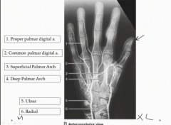 Look for the main artery supplying the arch-
If its radial-deep palmar arch
Ulnar-superficial palmar arch