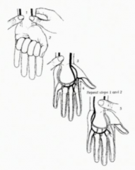 Test for patency of blood supply to hand
Steps:
1. Push down on the Radial and ulnar arteries while hand is raised with a clenched fist
2. Hold Down
3. Lower hand