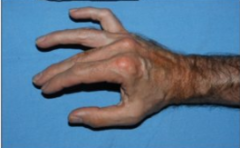-Hyperextension of MCP joints by ED
-and flexion of the IP joints by FDP
Clawed fourth and fifth digit with extension at MCP
"Claw Hand" Deformity