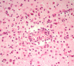 Mikroskopi av hjernevev etter hjerneinfarkt. Kan se store mengder makrofager. Hvor lang tid har det minst gått siden infarktet?