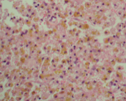 Bilde av hemosiderin-makrofager. Hva tyder dette funnet på?