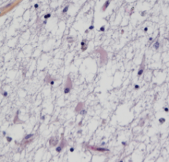 Mikroskopi fra hjernevev. Hvilke celler kan sees, og hva tyder dette utseendet på?