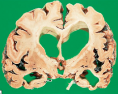 Hvilke to karakteristika ved denne hjernen tyder mest på Alzheimers sykdom?