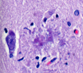 Fra histologisk snitt farget med hematoksylin/eosin. Hva kalles denne strukturen, og hvilken sykdom er den typisk for?