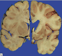Normal hjerne til venstre. Hvilken diagnose er mest sannsynlig til høyre?