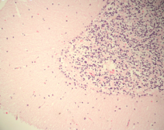 Histologisk snitt fra cerebellum med tap av Purkinjeceller og gliose. Hva er mest sannsynlige årsaker?
