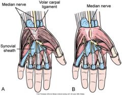 The median nerve and the volar carpal ligament.  Relief of carpal tunnel syndrome involves the decompression of the medial nerve by incision through the transverse carpal ligament.
