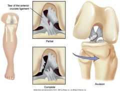 Most common knee injury. Injury can result in partial, complete, and avulsion (tearing away). Often reported as coming down on knee, twisting, and hearing a pop; followed by acute pain and swelling.