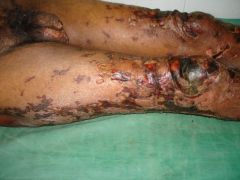 Type II/III (depending on what you read) reaction to lepromatous leprosy, see crops of painful hermorrhagic infarcts forming crusted ulcerations