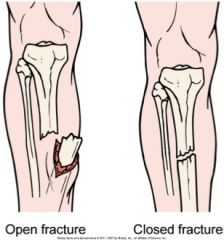 They are both classifications according to communication with the external environment.
Open (or compound) fracture is a brake in skin, exposing the bone and causing soft tissue injury.
Close (or simple) fracture is characterized by an intact an...