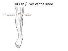 3*- Tx: Knee pain, Arthritis- Bi, weakness of knee joint, dec. ROM.