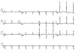 60 year old vascular patient. ECG given.
Showed large positive R waves in lateral leads, large negative S waves in anterior leads. ST depression laterally  ie LVH with strain; bicuspid p waves
A.	LVH with strain
B.	Enlarged RA
C.	Lateral ischaemia
D