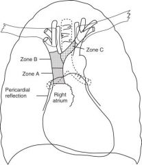 B

	Zone A represents the lower SVC and upper RA. In this zone CVCs placed from the left side are likely to lie parallel to the vessel walls. However, a part of this zone lies within the RA and therefore within the pericardial reflection. This may repr
