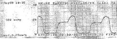 The following capnograph tracing is most likely to represent
 
A.	partial obstruction of sampling tube
B.	sticking ventilator bellows
C.	incomplete neuromuscular blockade
D.	air entrainment into sampling tube
E.	partial obstruction of endotracheal t