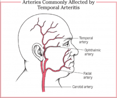 *Most common vasculitis.

*Classified as a large vessel vasculitis:
-Can affect aorta.
-Predominantly affects medium-sized and small arteries, especially the cranial arteries.

*Disease of older people (>50).

*Temporal, opthalmic, facial ...