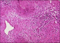 *Lumen of artery at left. Arrow points to giant cell. 
*Note granuloma and inflammatory cells.
*Giant Cell (Temporal) Arteritis.