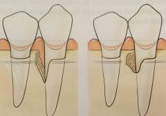 results from periodontitis, different types of defects in alveolar bone