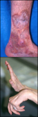 *Skin involvement and wrist drop due to nerve involvement in Polyarteritis Nodosa.