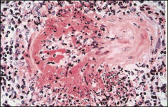 *Polyarteritis Nodosa: Acute Phase:
-Transmural infiltration by polys, eosinophils, and lymphocytes.
-Fibrinoid necrosis of vessel wall.
-Note sparing of portion of circumference.