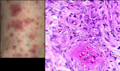 *Cutaneous leukocytoclastic vasculitis: clinically shows as purpura.  Polys infiltrate vascular wall and surrounding tissue, with fragmentation of nuclei--> “nuclear dust.”

*Fibrin and immunoglobulin deposition imparts a smudgy appearance.
...