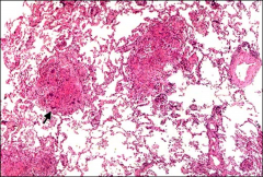 *Churg-Strauss syndrome.
*Lung tissue. Some alveoli (arrow) have dense accumulations of inflammatory cells. Eosinophils and neutrophils.
