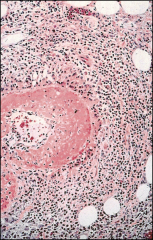 *Churg-Strauss Syndrome.
*Fibrinoid necrosis of artery.
*Bordered by granulomatous inflammation.
*Surrounded by eosinophils.