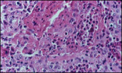 *Churg-Strauss Syndrome.
*Bordered by granulomatous inflammation.