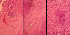 *Left: Granulomatous inflammation surrounding a blood vessel and a bronchus.
*Mid: Perivascular granuloma (top left) with central necrosis.
*Right: A granuloma with central necrosis and giant cell (arrow).
