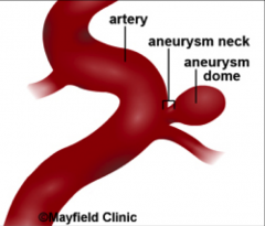 *A special group of saccular aneurysms.
*Thin-walled outpouchings at branch points in Circle of Willis; 1-3 mm.
*Wide or narrow neck.
*Rupture occurs at apex of sac--> can lead to SAH.
