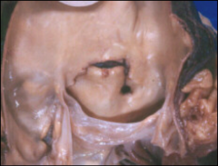 *Aortic dissection - Intimal tear.
*Aortic valve is visible.